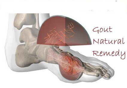 natural remedy for gout